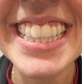 powellaligner0002