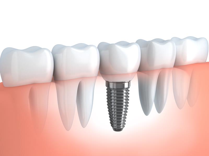 Dental Implants Laingsburg, MI