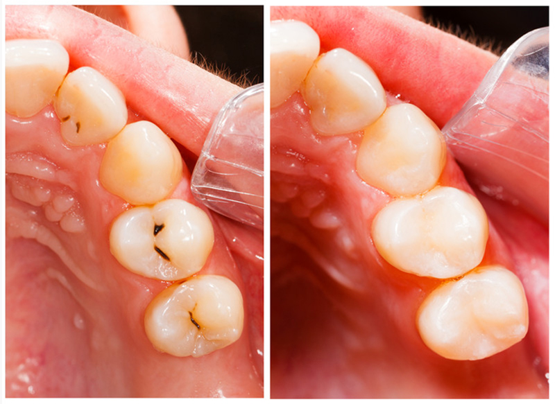 Fillings Laingsburg, MI