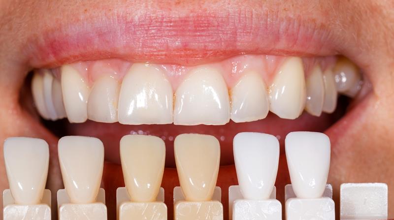Veneers Laingsburg, MI